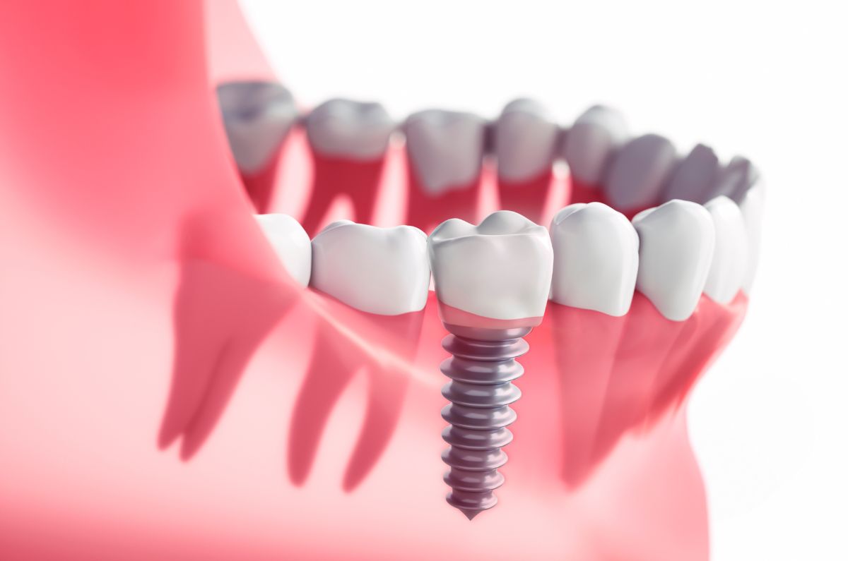 Dental Implants